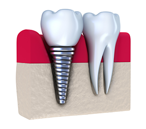 Dental Implants | Dentist in in Fort Lauderdale, FL | All On Four Inc